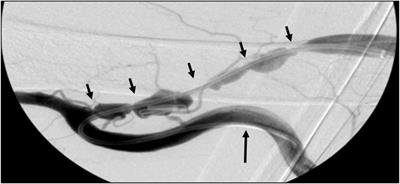 Stent Grafts Can Convert Unusable Upper Arm Arteriovenous Fistulas into a Functioning Hemodialysis Access: A Retrospective Case Series